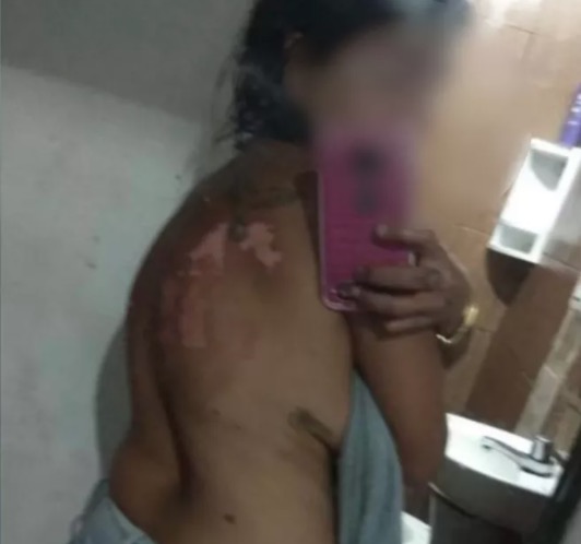 Homem tem crise de ciúmes e joga óleo quente na própria companheira