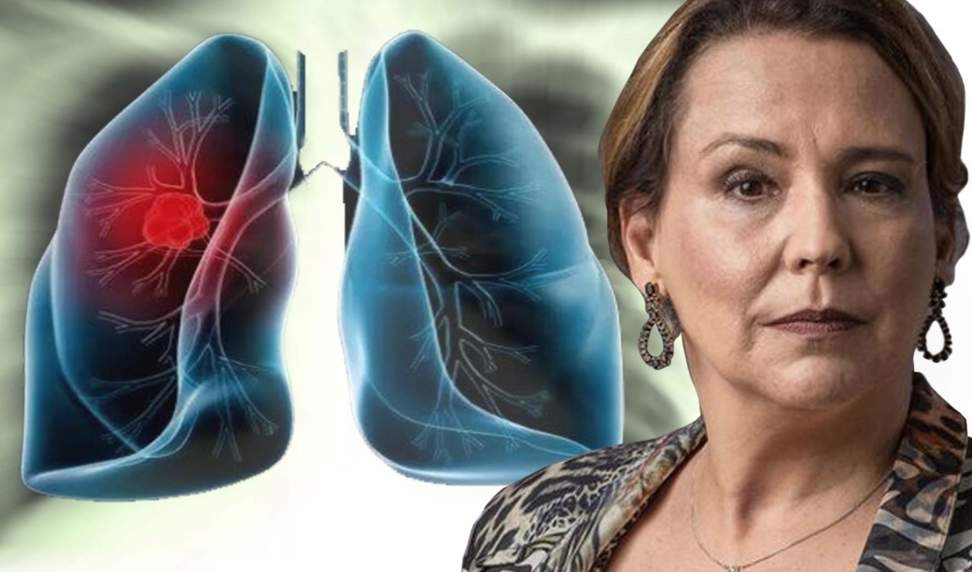 Câncer de Pulmão: Saiba as causas, sintomas e tratamento da doença de Ana Beatriz Nogueira