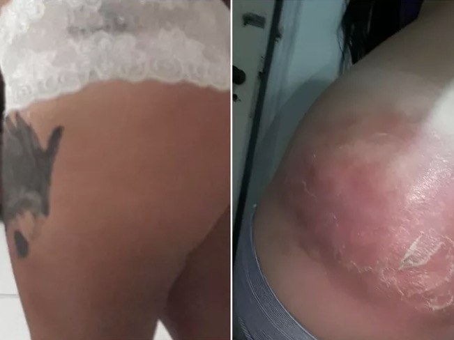Mulher fica com bumbum deformado após injeção em unidade de saúde 