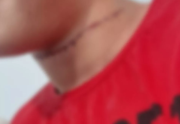 Linha de cerol corta pescoço de menino que andava de bicicleta em parquinho