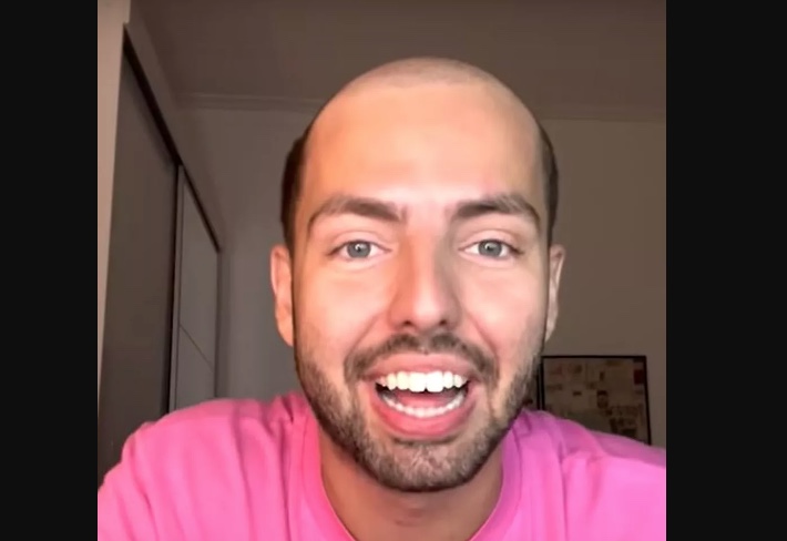 Corte de cabelo que imita calvície vira moda entre brasileiros