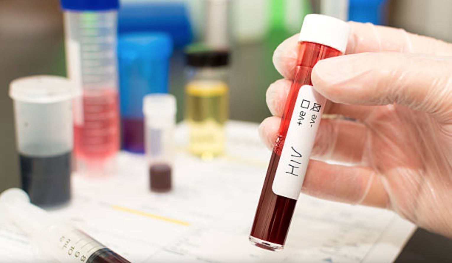 Nova cura de paciente com HIV não é aplicável em larga escala