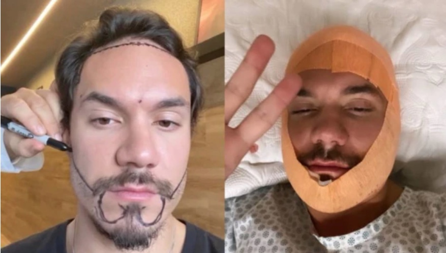 Ex-BBB Eliezer realiza transplante de cabelo e barba para ‘corrigir falhas’