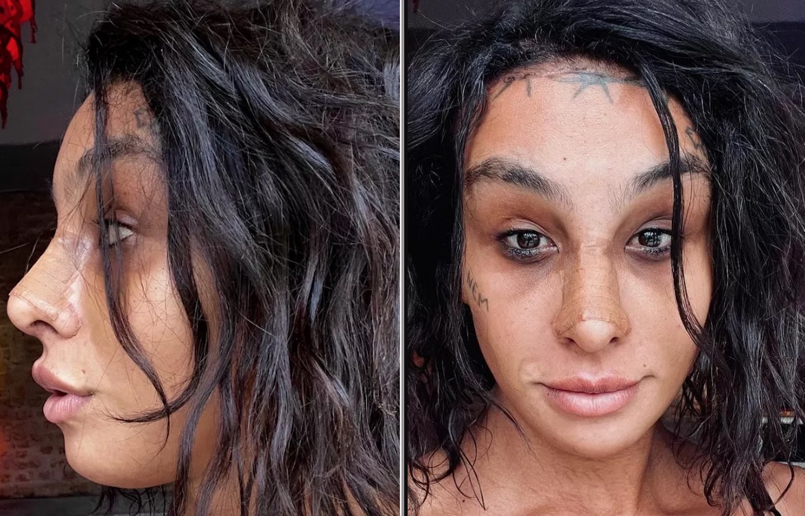 Linn da Quebrada mostra resultado de cirurgia de feminilização no rosto