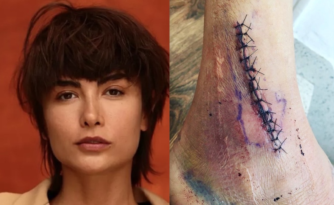 Imagem forte: Maria Casadeval mostra tornozelo fraturado após queda