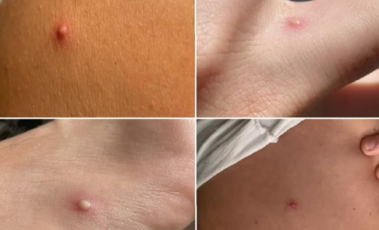 Brasil registra casos de varíola dos macacos em dois bebês