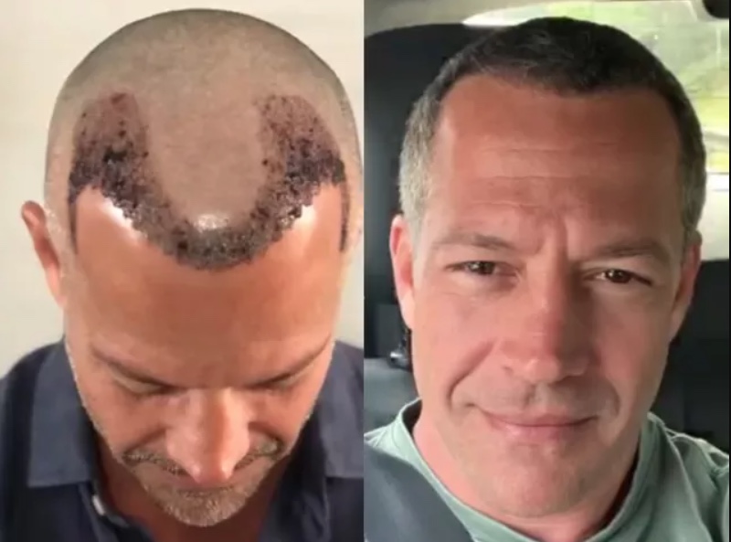 Ex-calvo: Malvino Salvador mostra resultado de transplante capilar