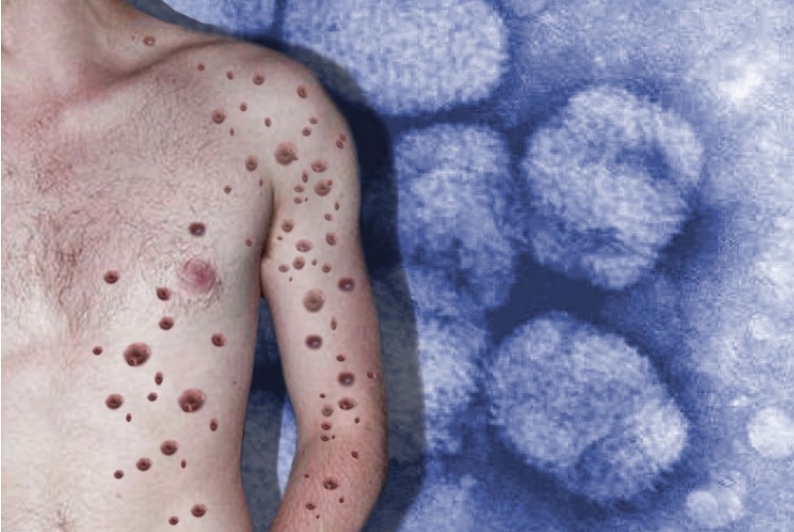 Amazonas investiga mais 29 casos suspeitos de varíola dos macacos