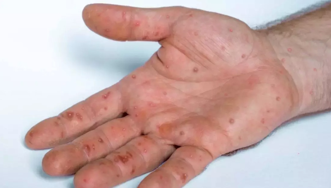 Amazonas tem 32 casos de varíola dos macacos em investigação