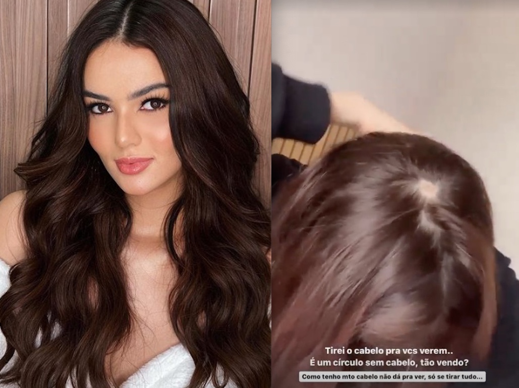 Ex-BBB Eslovênia descobre doença autoimune: ‘bizarro’