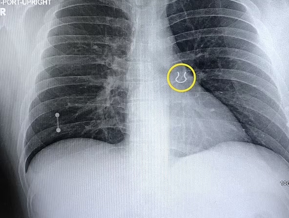 Após tosse severa, homem descobre piercing dentro do pulmão