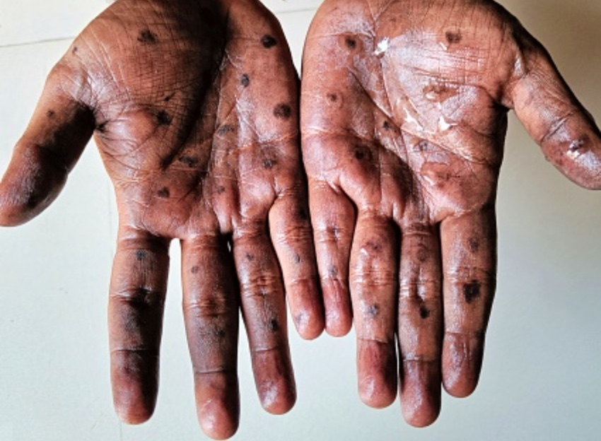 Manaus concentra 99% dos casos de varíola de macacos no estado; veja dados