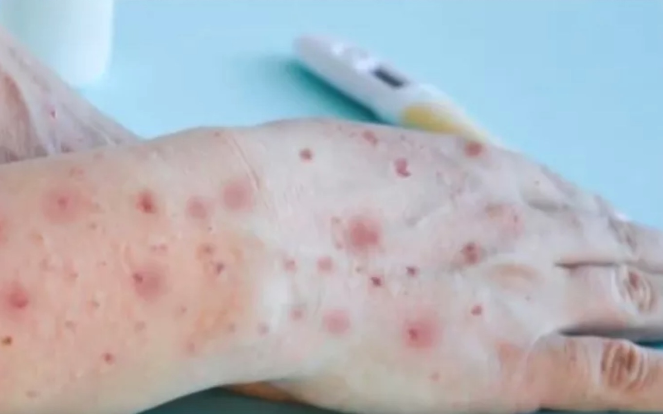 Casos de Varíola dos Macacos sobem para 122 no Amazonas