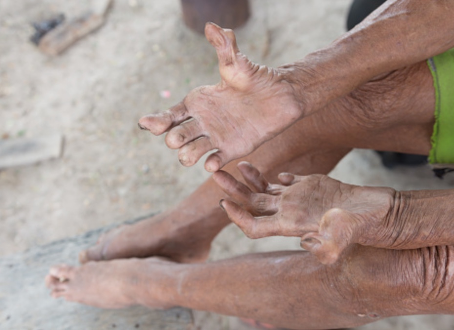 Com 222 novos casos de hanseníase, governo intensifica ações no Amazonas