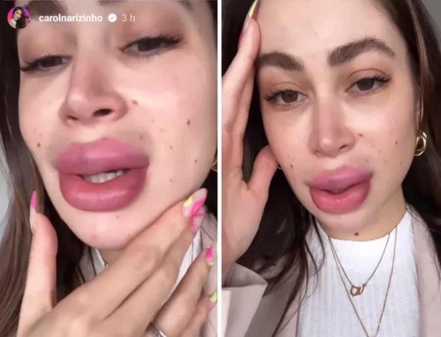 Carol Narizinho mostra boca 'deformada' após retirar preenchimento