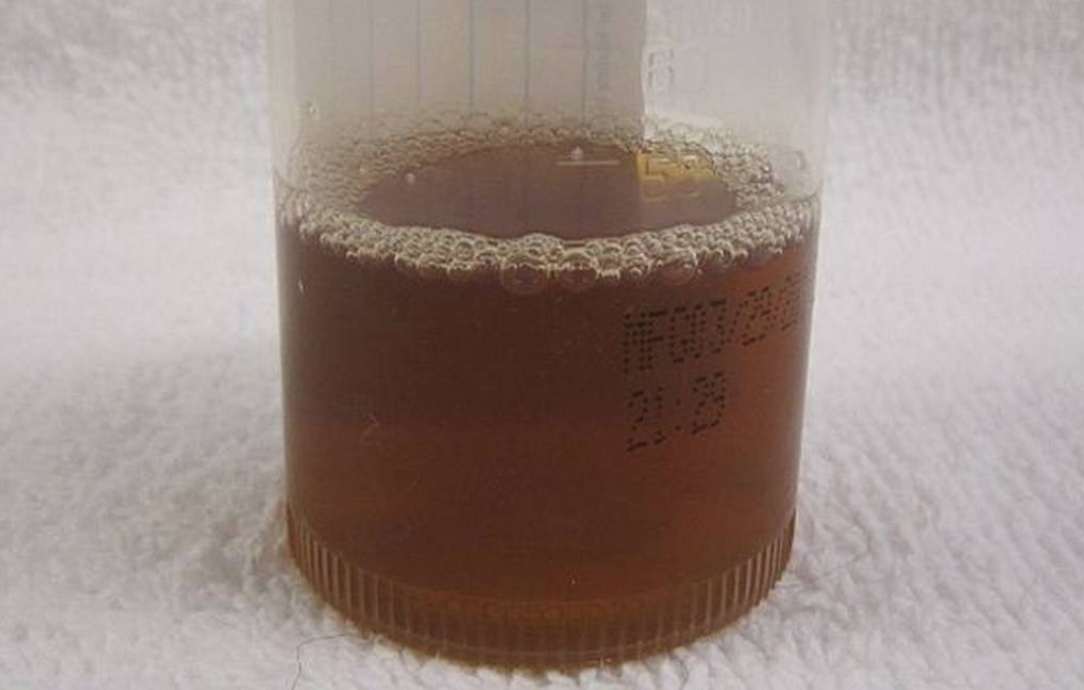 Amazonas chega a 100 casos da doença da urina preta e sete estão internados