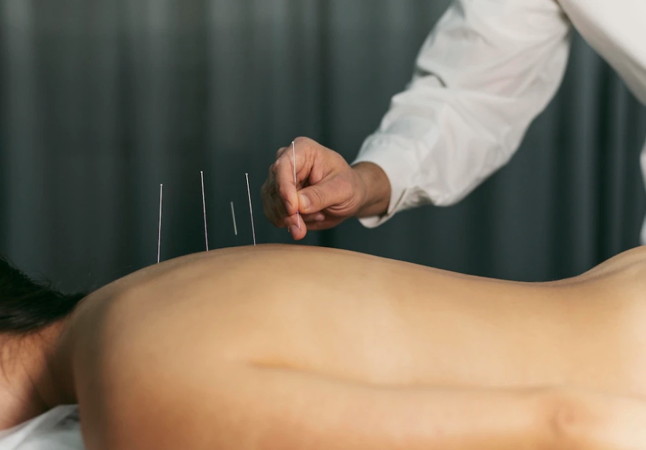 Projeto quer obrigar SUS a ofertar acupuntura e homeopatia