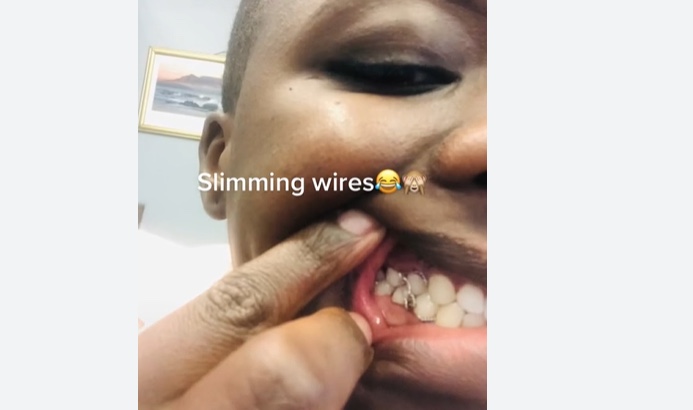 Para emagrecer, mulher usa aparelho para 'trancar' os dentes por 7 semanas