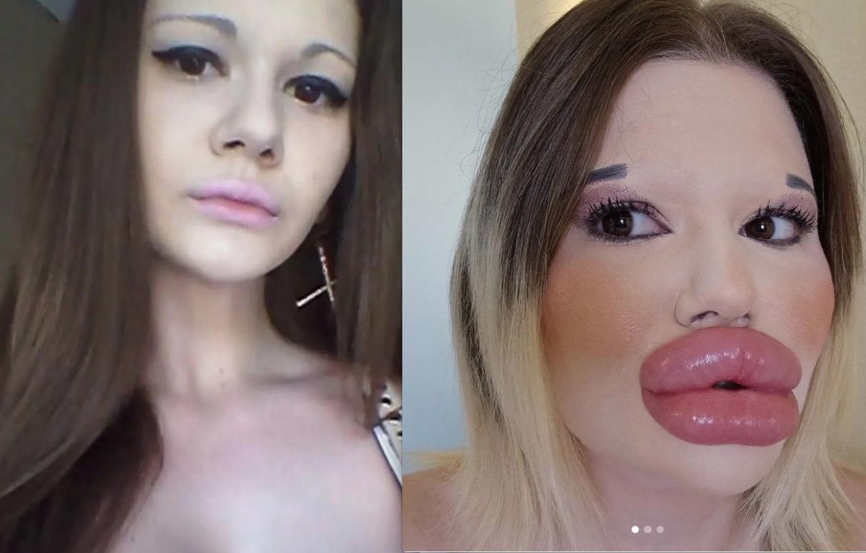 Após 30 preenchimentos, Barbie Humana choca com maior boca do mundo