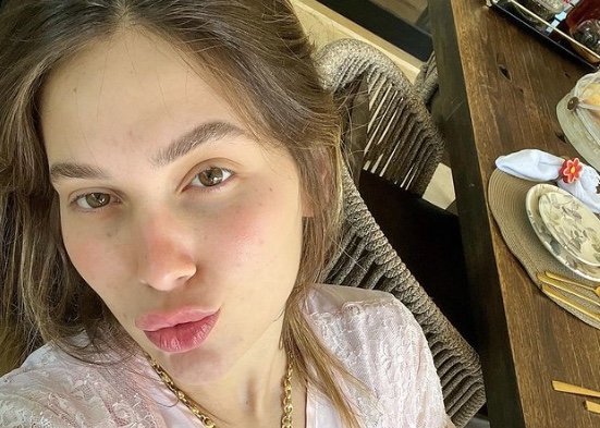 Virginia faz procedimento estético para empinar nariz; veja antes e depois 