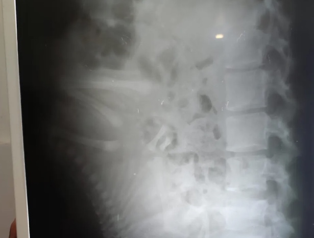 Mulher sente dores nas costas e descobre gravidez na hora do parto