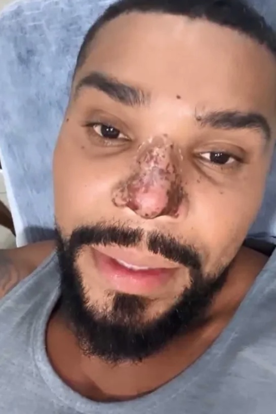 Entenda os motivos que podem ter causado necrose no nariz do cantor Naldo Benny