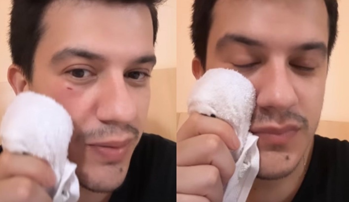 Hugo, dupla de Guilherme, sofre corte no rosto após ser atingido por celular