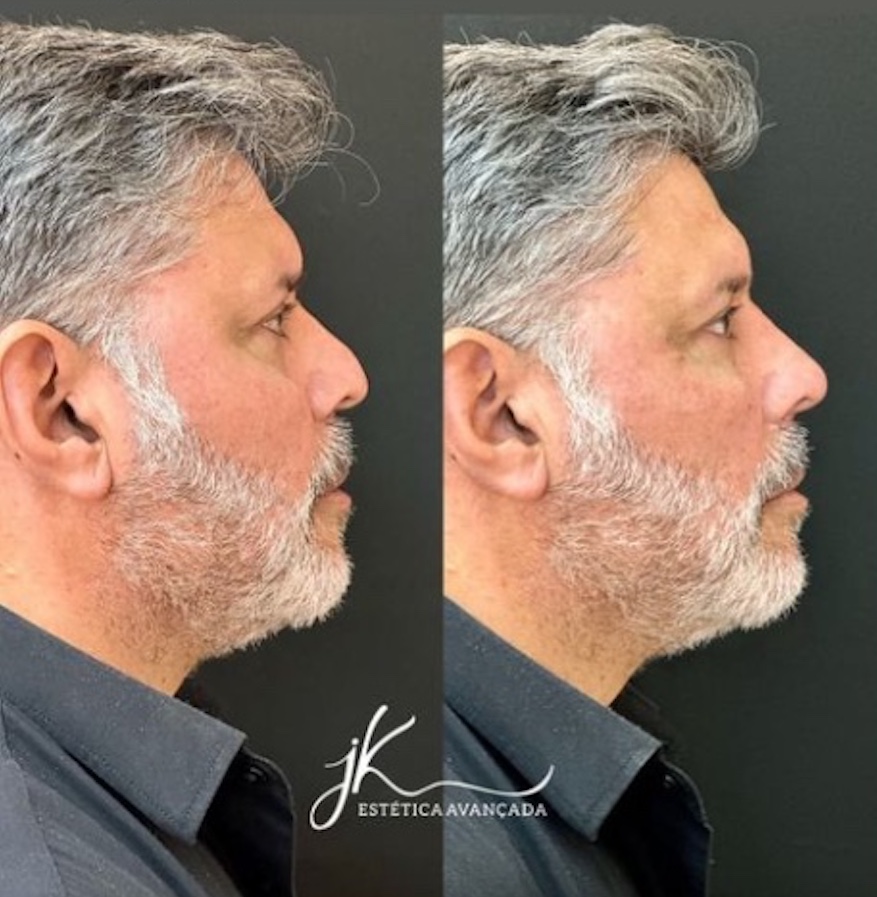 Alexandre Frota faz harmonização facial e mostra resultado