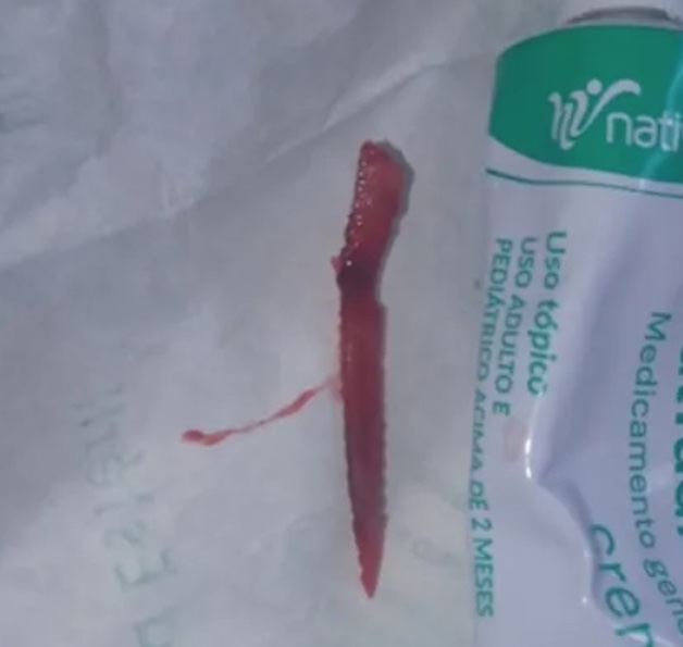 Menina é perfurada por ferrão de peixe venenoso enquanto nadava em rio