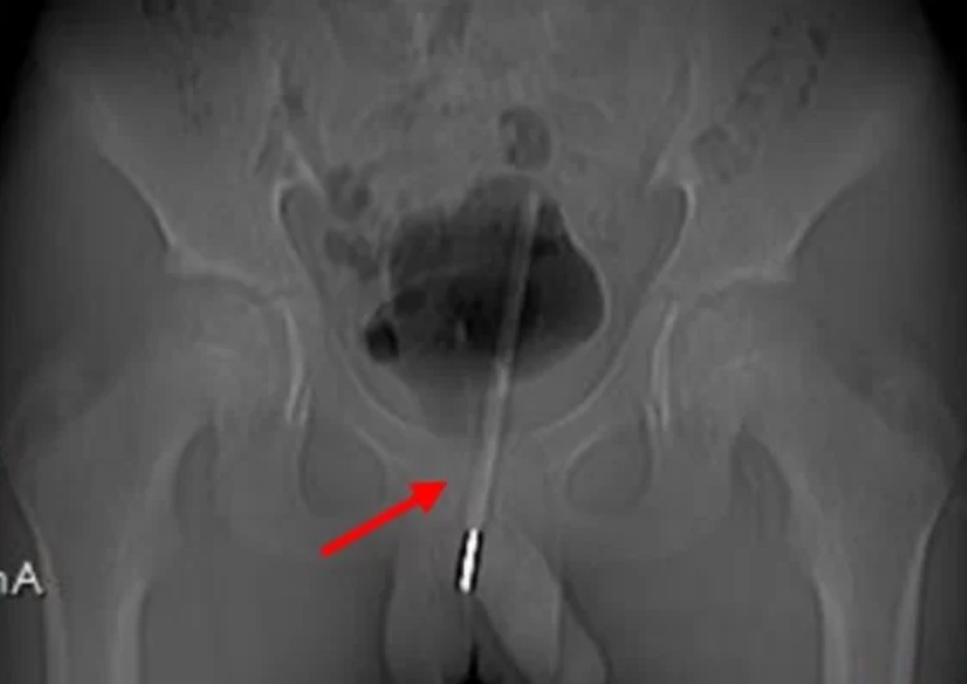 Menino de 12 anos fica com termômetro preso no pênis após se masturbar