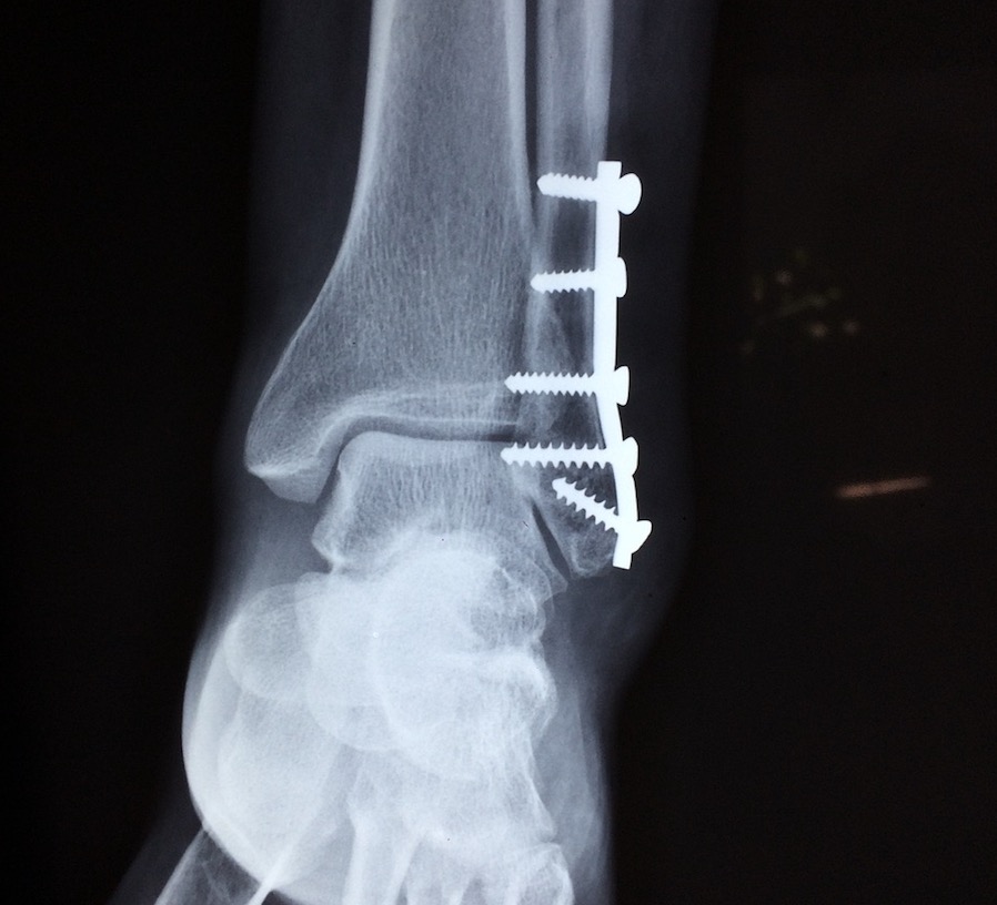 Osteoporose atinge 1 a cada 3 mulheres e tratamento precoce evita fraturas