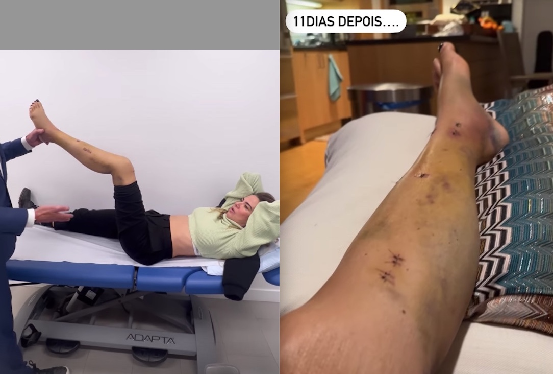 Luciana Gimenez mostra como ficou perna após acidente: ‘não se assustem’