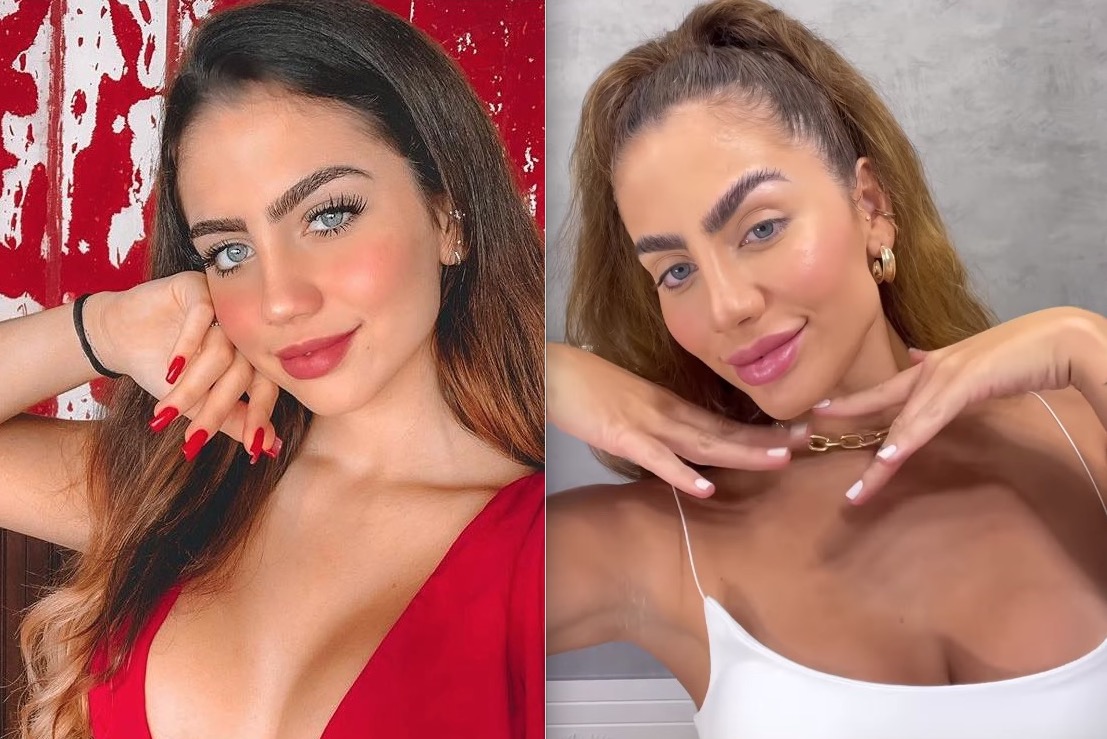 Catherine Bascoy choca ao mostrar rosto após harmonização facial 