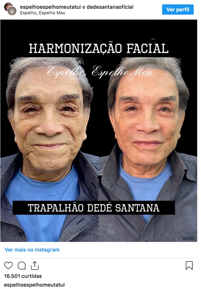 Aos 86 anos, Dedé Santana mostra antes e depois de harmonização facial 