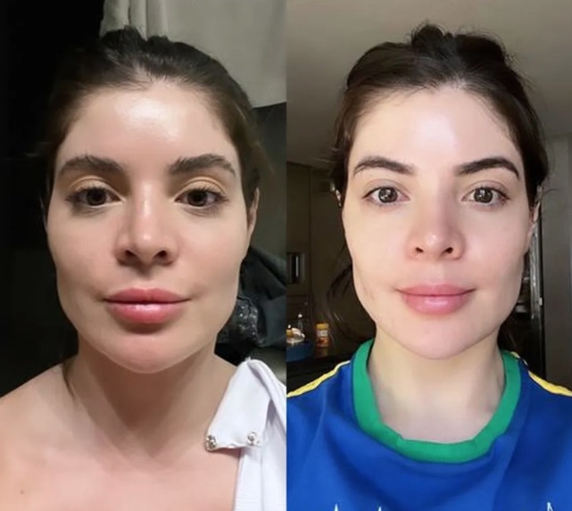 Gkay retira preenchimento do rosto e choca com antes de depois 