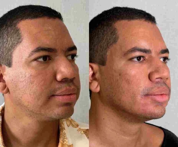 Ex-BBB Bruno Gaga faz harmonização facial e resultado não surpreende