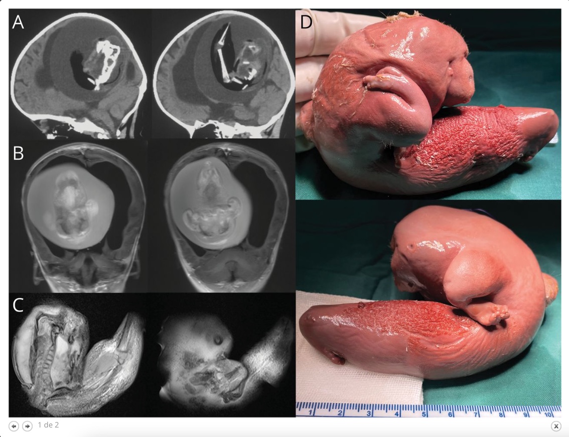 Médicos retiram feto que cresceu no cérebro de menina de 1 ano