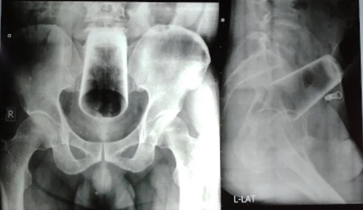 Homem enfia copo de vidro de 12 cm no ânus durante bebedeira