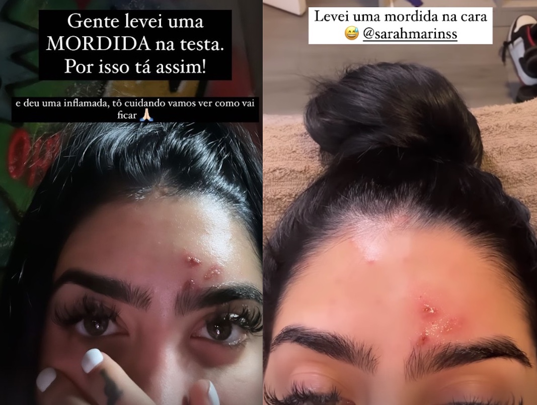 MC Mirella é mordida na testa por macaco de estimação: 'deu uma inflamada'