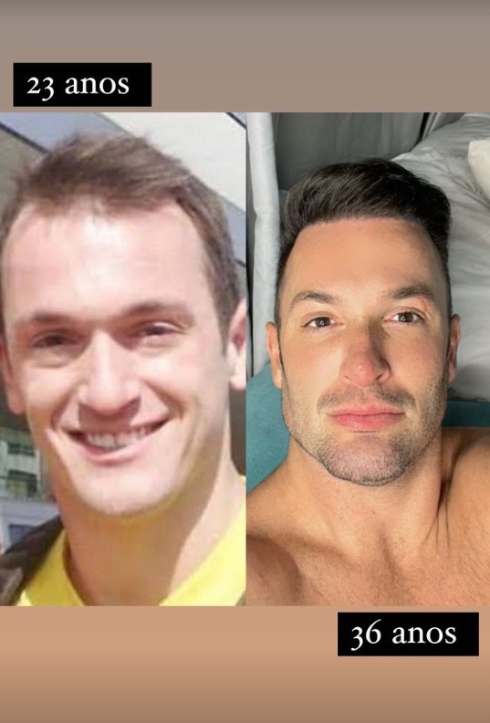 Diego Hypolito faz nova harmonização facial e mostra resultado