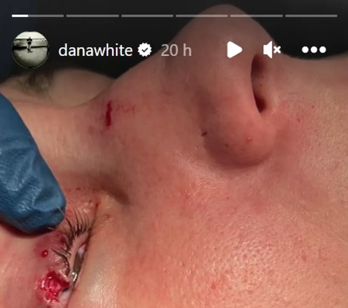 Dana White mostra corte no rosto de Karol Rosa após UFC