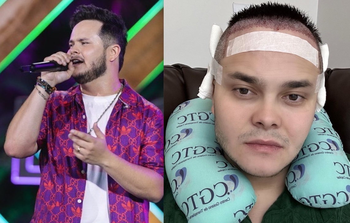 Após lipo HD, Matheus da dupla com Kauan faz transplante capilar 
