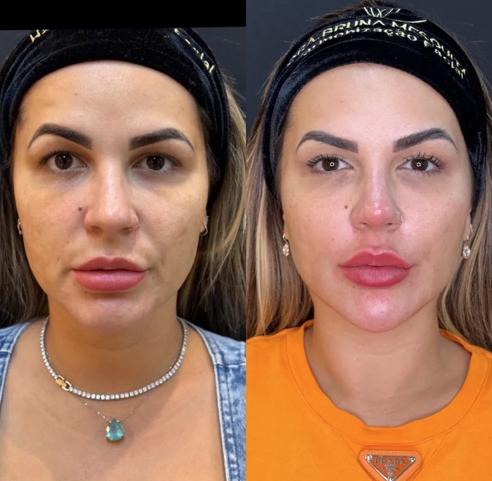 Deolane retira preenchimento e faz nova harmonização facial; veja antes e depois