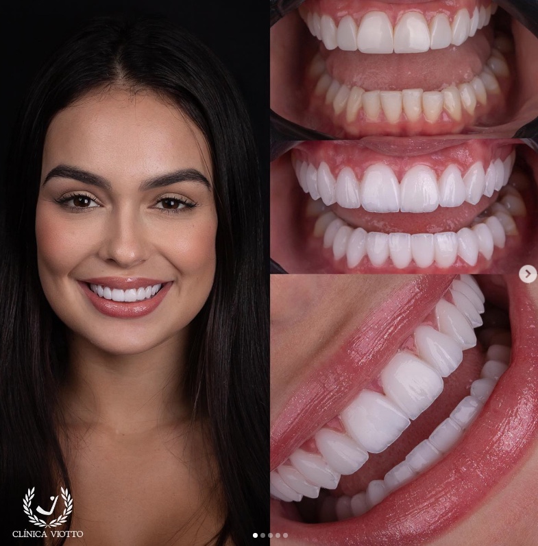 Ex-BBB Larissa troca lentes dos dentes e mostra novo sorriso