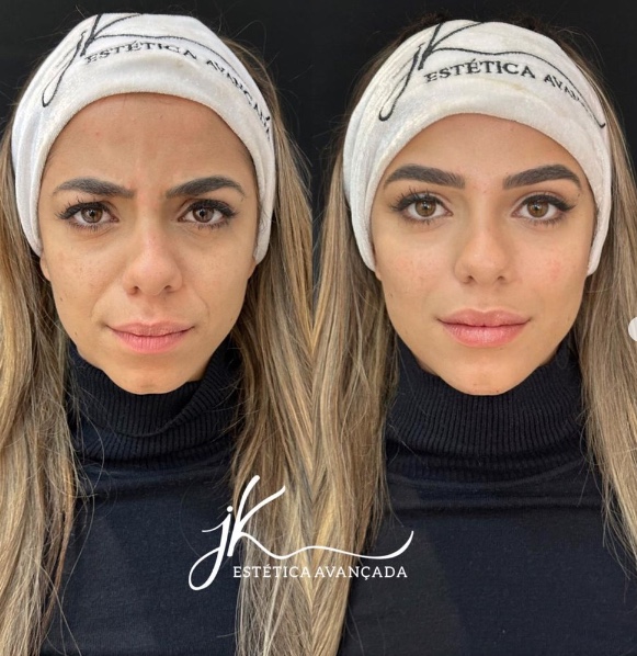 Ex-BBB Key Alves faz harmonização facial; Veja antes e depois 