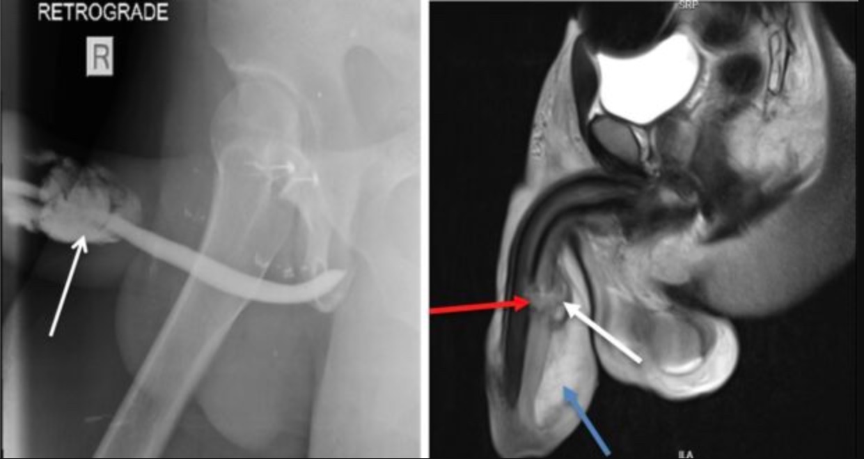 Homem quebra o pênis em 3 partes após 'sentada mortal' da namorada