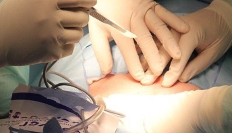 Hospital indeniza mulher que teve bexiga rompida no parto e sofreu infecção