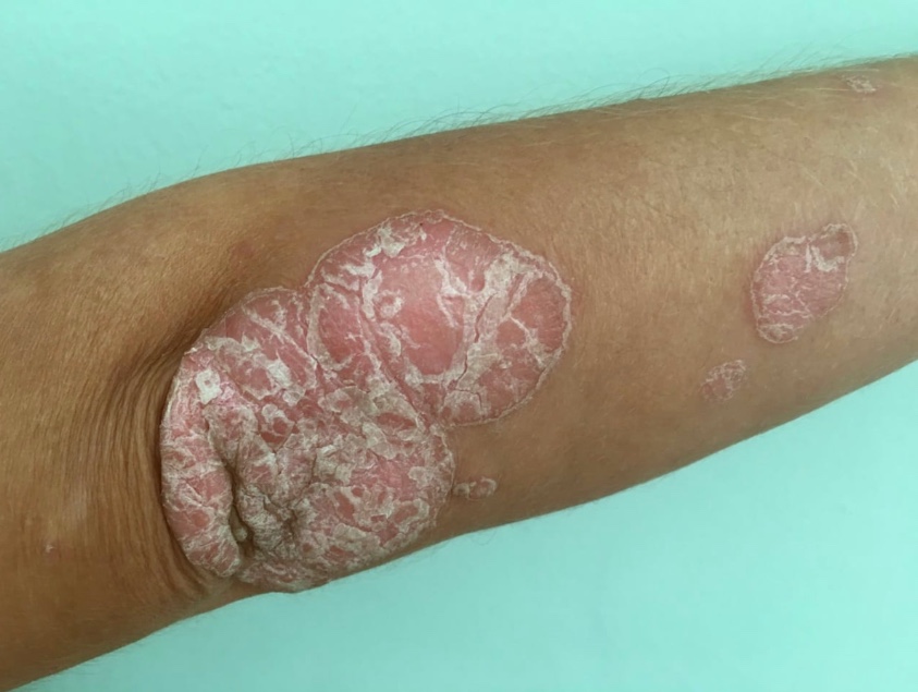 Amazonas vai reforçar ações contra doenças de pele em 12 municípios