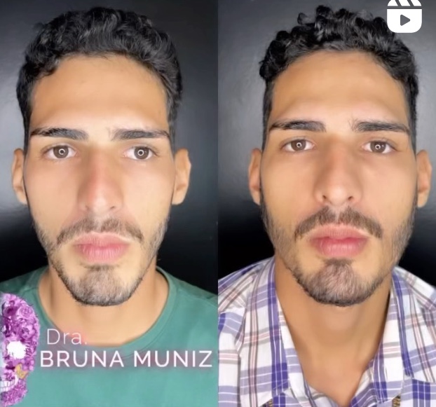 Agenor Tupinambá, da capivara Filó, faz harmonização facial 