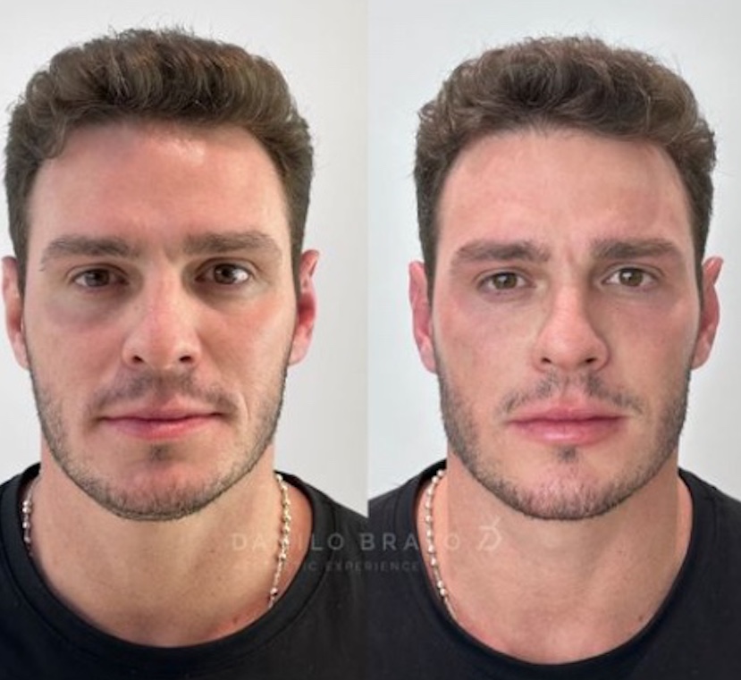 Ex-BBB Gustavo Cowboy faz harmonização facial e mostra resultado